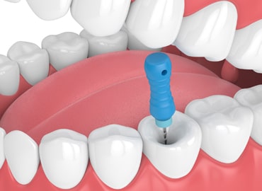 root-canal