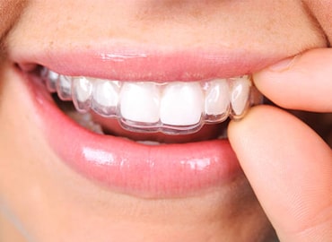 aligner