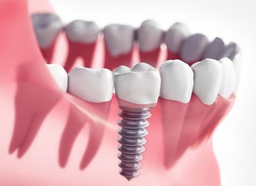 implant
