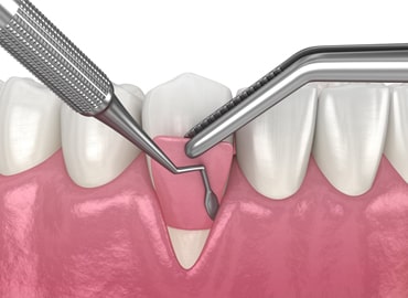 Oral / Soft-Tissue Surgeries