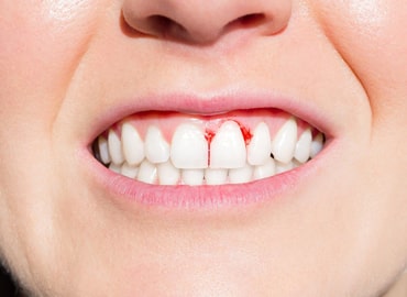 Bleeding of Gums