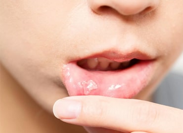 Ulcers